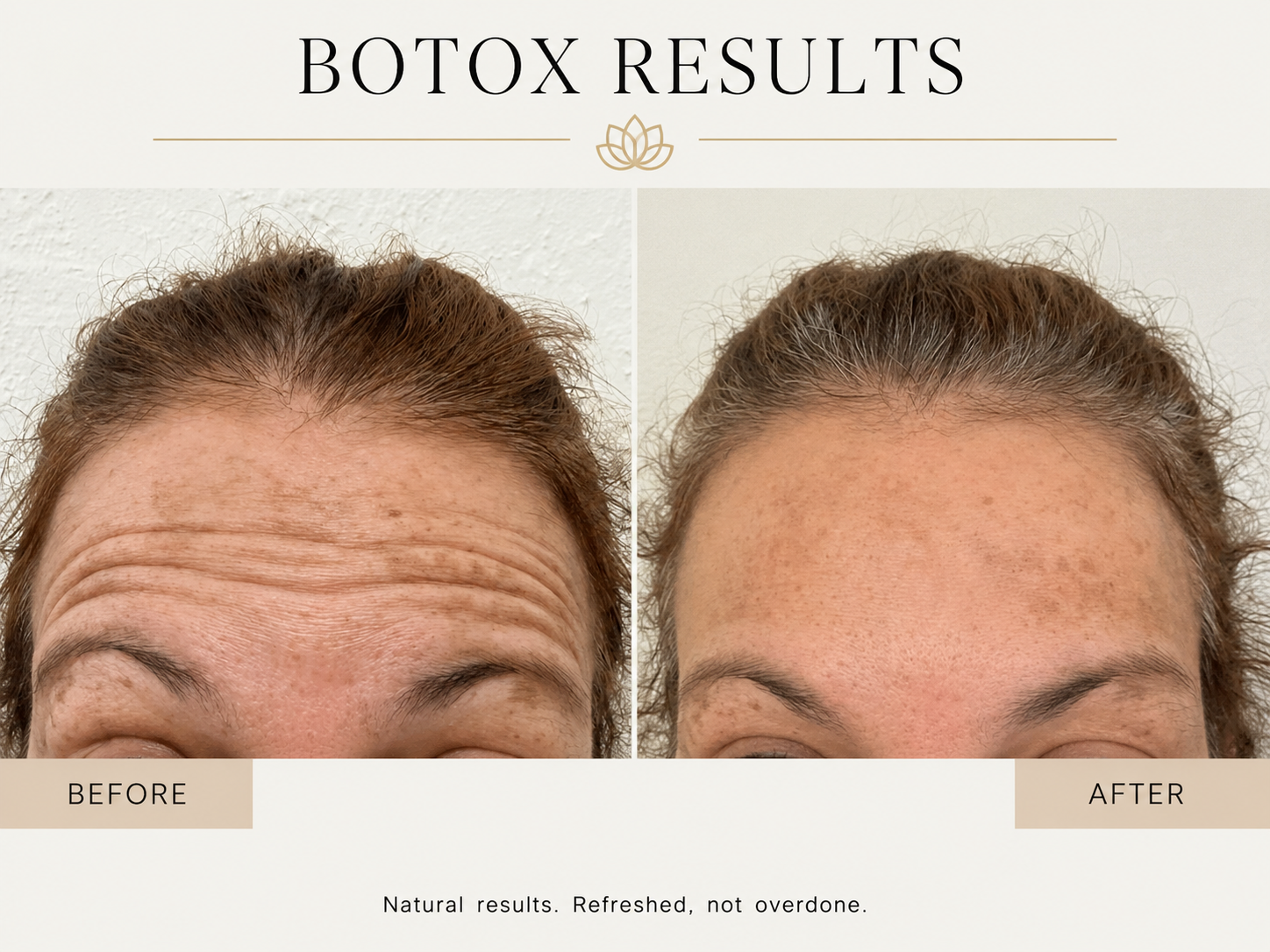 Botox before and after results